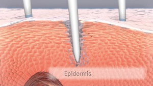 Grafische Querschnittsdarstellung der Haut: Mehrere feine Nadeln dringen in die Epidermis ein; die oberste Hautschicht ist deutlich beschriftet und schematisch dargestellt